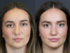 Revision Rhinoplasty case #11743 slider thumbnail