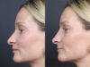 Liquid Rhinoplasty case #11755 slider thumbnail