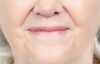 Lip Lift case #11784