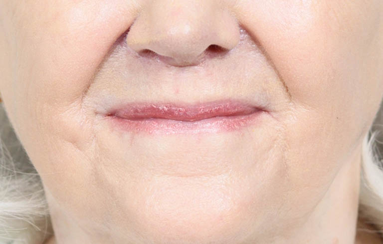 Lip Lift case #11784