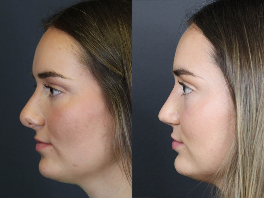 Revision Rhinoplasty case #11743