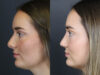 Revision Rhinoplasty case #11743 slider thumbnail