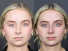 Liquid Rhinoplasty case #11757 slider thumbnail