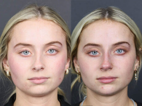 Liquid Rhinoplasty case #11757