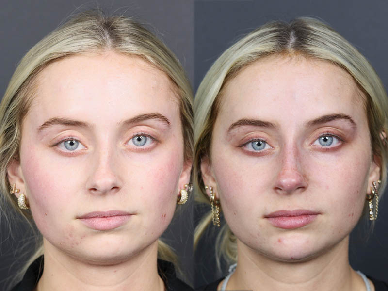 Liquid Rhinoplasty case #11757