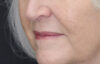 Lip Lift case #11784