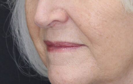 Lip Lift case #11784