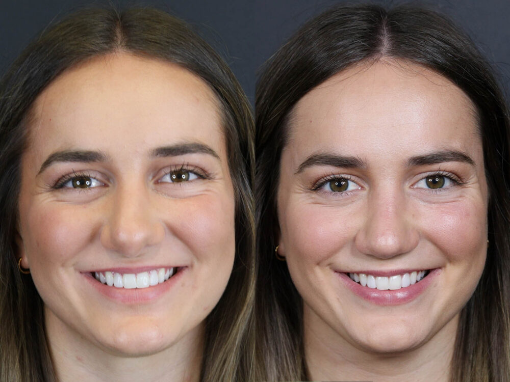 Revision Rhinoplasty case #11743