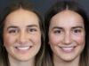 Revision Rhinoplasty case #11743 slider thumbnail