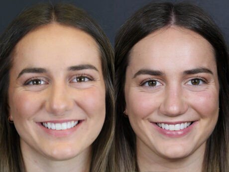 Revision Rhinoplasty case #11743