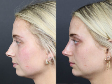 Liquid Rhinoplasty case #11757