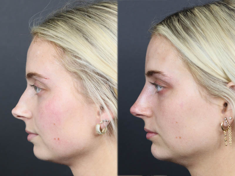 Liquid Rhinoplasty case #11757