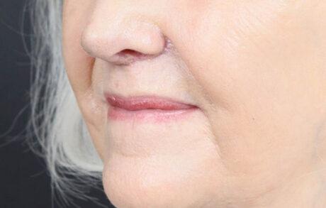 Lip Lift case #11784