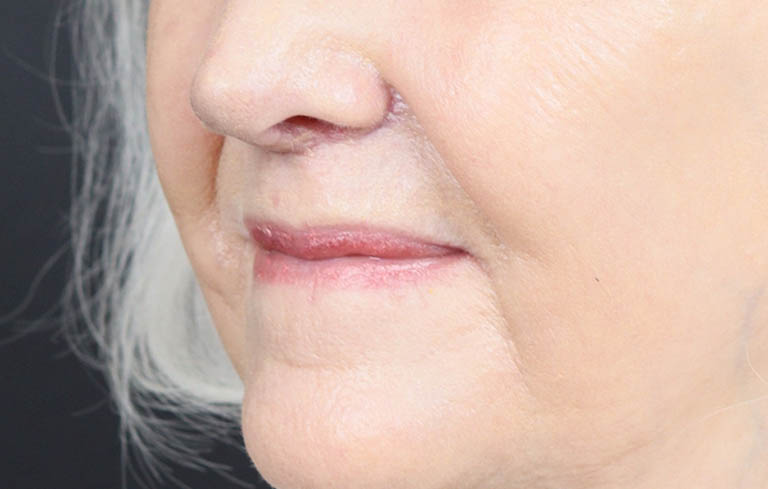 Lip Lift case #11784