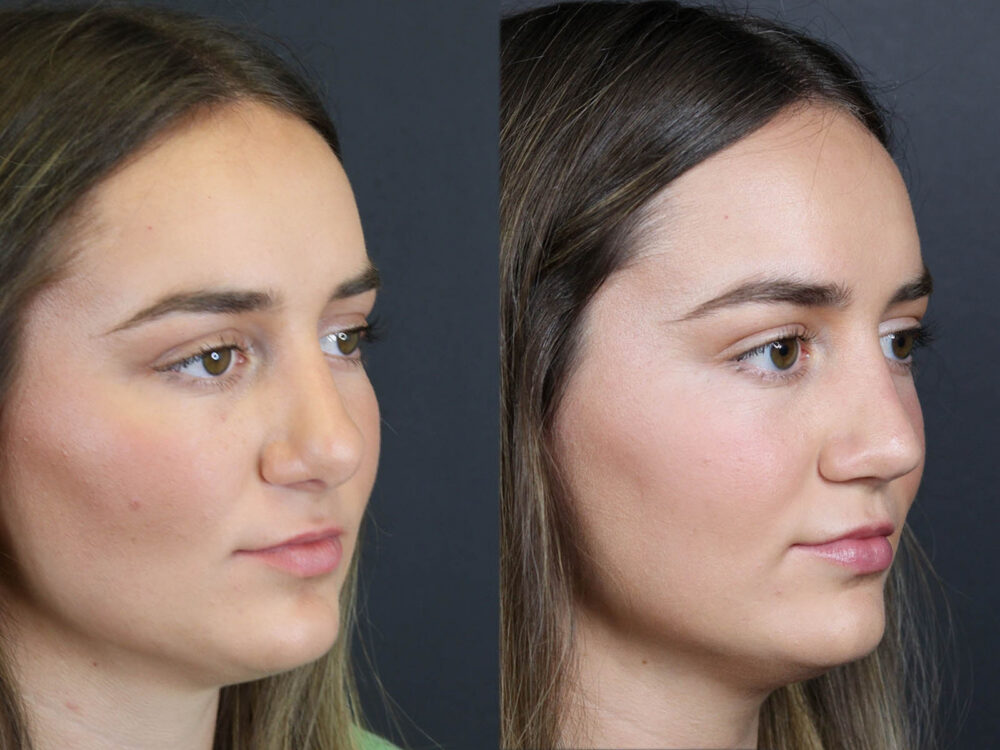 Revision Rhinoplasty case #11743