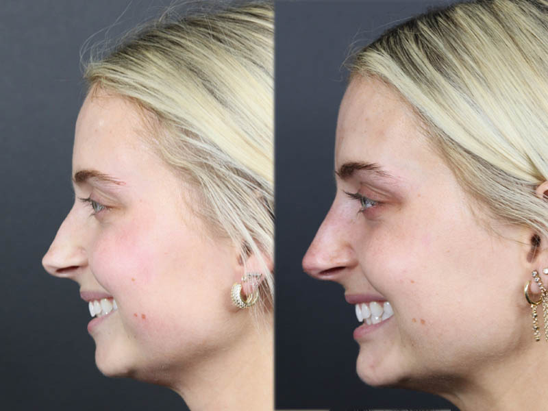 Liquid Rhinoplasty case #11757