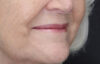 Lip Lift case #11784