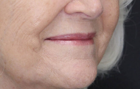 Lip Lift case #11784