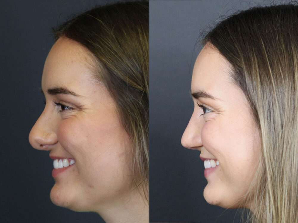 Revision Rhinoplasty case #11743