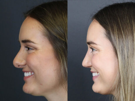 Revision Rhinoplasty case #11743