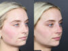 Liquid Rhinoplasty case #11757 slider thumbnail