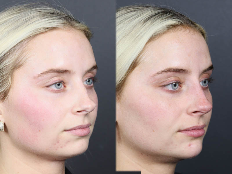 Liquid Rhinoplasty case #11757