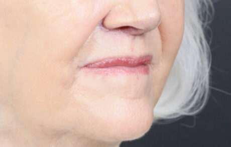 Lip Lift case #11784