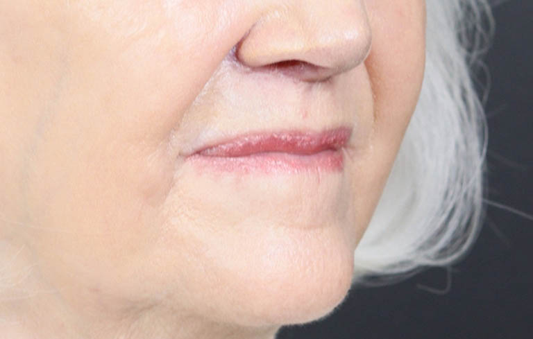 Lip Lift case #11784