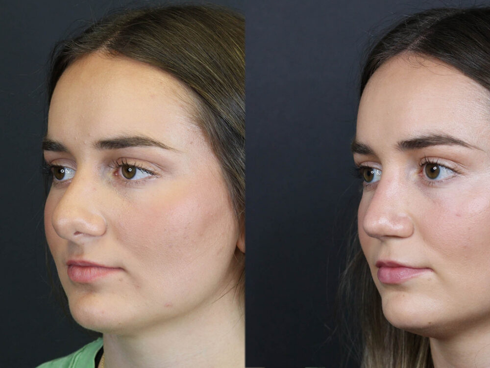 Revision Rhinoplasty case #11743