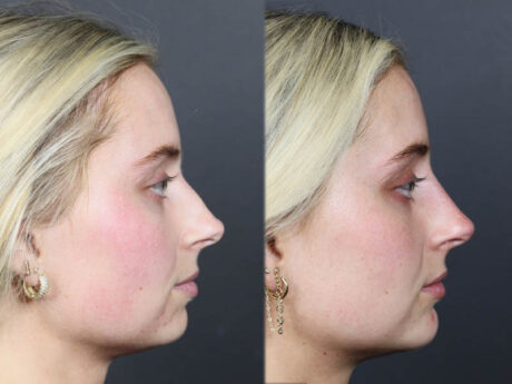 Liquid Rhinoplasty case #11757