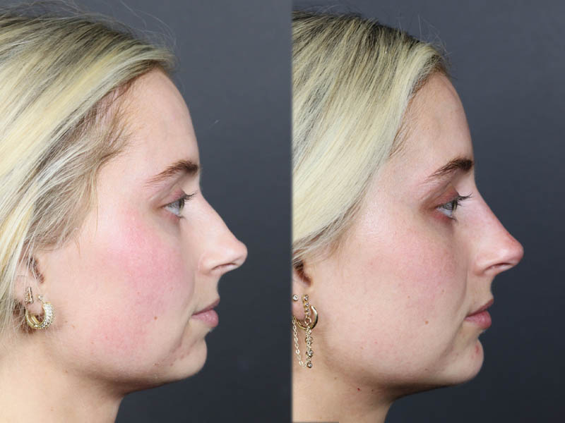 Liquid Rhinoplasty case #11757