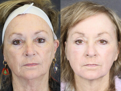 Deep Chemical Peel case #11764