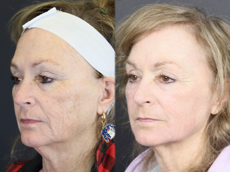 Deep Chemical Peel case #11764