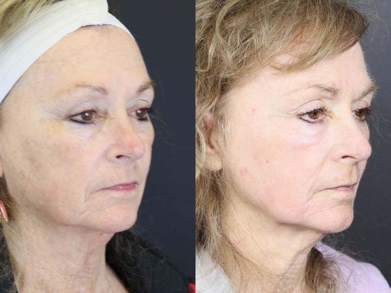 Deep Chemical Peel case #11764