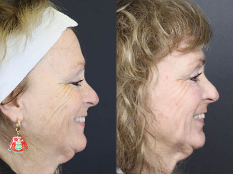 Deep Chemical Peel case #11764