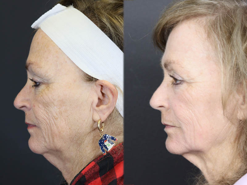 Deep Chemical Peel case #11764