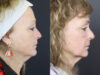 Deep Chemical Peel case #11764 slider thumbnail