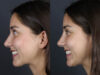 Liquid Rhinoplasty case #11771 slider thumbnail