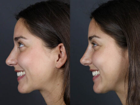 Liquid Rhinoplasty case #11771