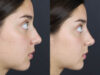 Liquid Rhinoplasty case #11771 slider thumbnail
