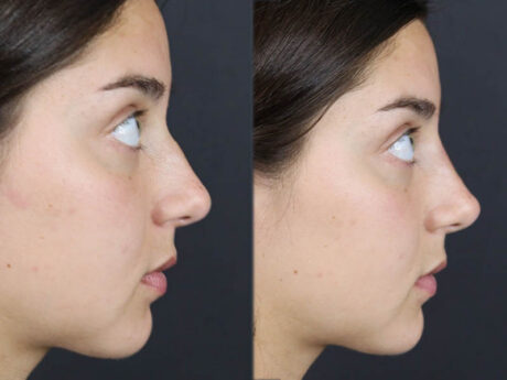Liquid Rhinoplasty case #11771