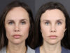 Hairline Lowering case #11752 slider thumbnail