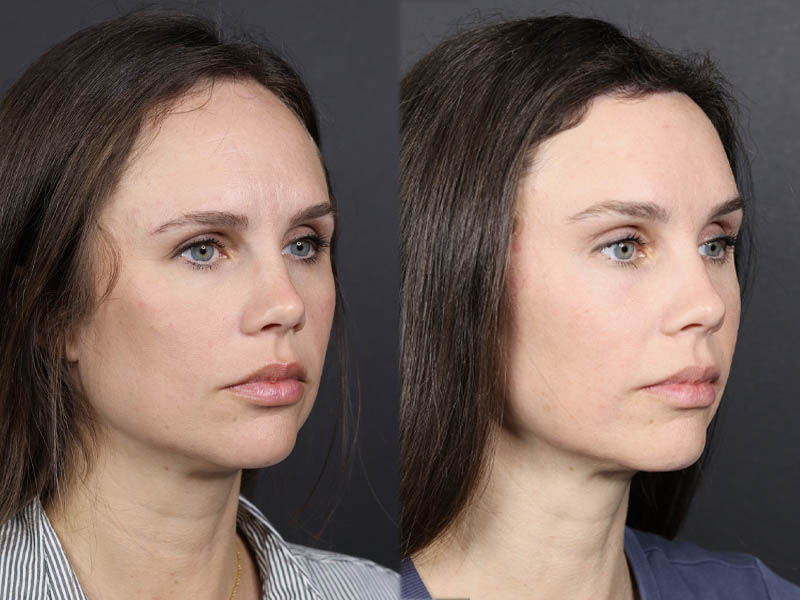 Hairline Lowering case #11752