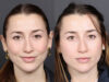 Liquid Rhinoplasty case #11774 slider thumbnail
