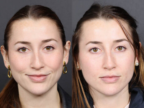 Liquid Rhinoplasty case #11774