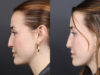 Liquid Rhinoplasty case #11774 slider thumbnail