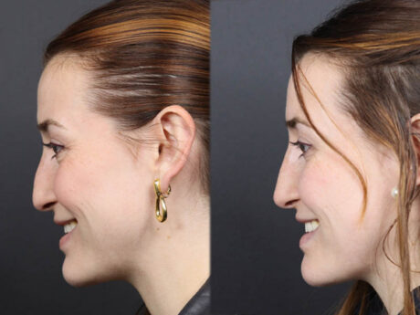 Liquid Rhinoplasty case #11774