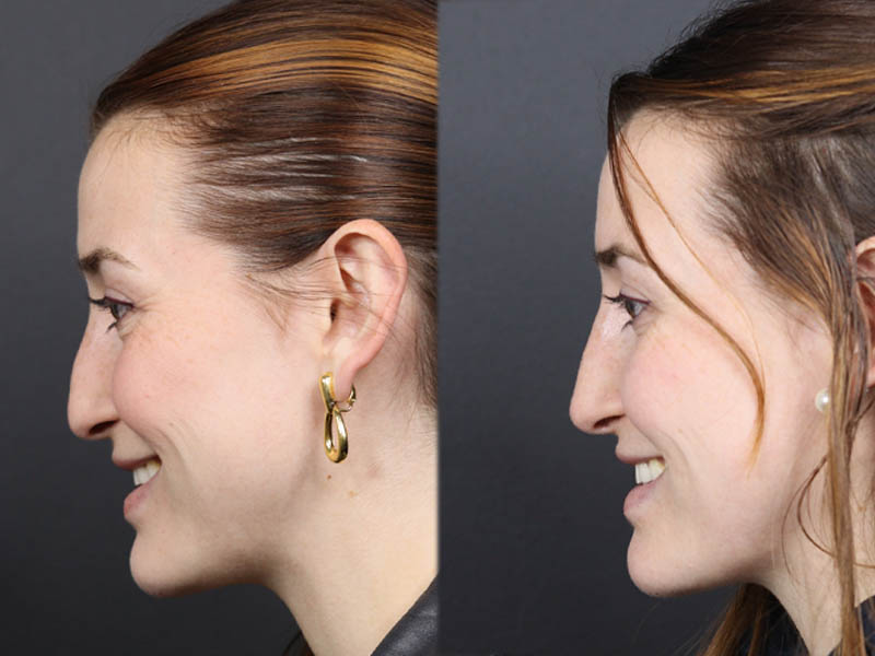 Liquid Rhinoplasty case #11774