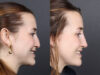 Liquid Rhinoplasty case #11774 slider thumbnail