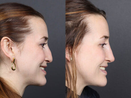 Liquid Rhinoplasty case #11774